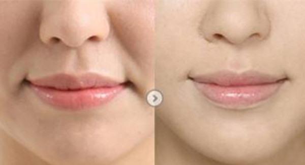 做光子<a href=http://www.f3bb6.cn/listinfo-792-0.html target=_blank class=infotextkey>去法令紋</a>手術(shù)注意事項是什么?