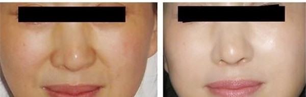 <a href=http://www.f3bb6.cn/listinfo-792-0.html target=_blank class=infotextkey>去法令紋</a>失敗修復不適合哪種人？