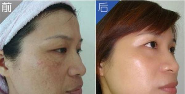 做<a href=http://www.f3bb6.cn/listinfo-786-0.html target=_blank class=infotextkey>去黃褐斑</a>手術多少錢?