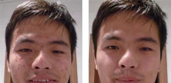 做切開填充治療痘疤手術(shù)多少錢?