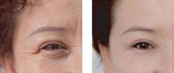 做E光<a href=http://www.f3bb6.cn/listinfo-780-0.html target=_blank class=infotextkey>去魚尾紋</a>手術多少錢？