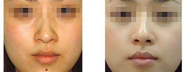 光子<a href=http://www.f3bb6.cn/listinfo-792-0.html target=_blank class=infotextkey>去法令紋</a>手術注意事項是什么？