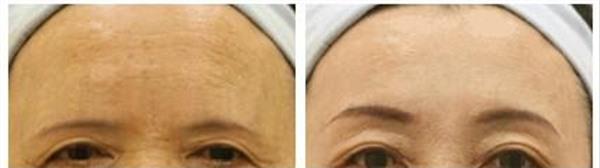 激光去除抬頭紋手術注意事項是什么?