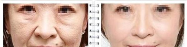 內窺鏡<a href=http://www.f3bb6.cn/listinfo-614-0.html target=_blank class=infotextkey>除皺</a><a href=http://www.f3bb6.cn/listinfo-780-0.html target=_blank class=infotextkey>去魚尾紋</a>手術效果好不好？