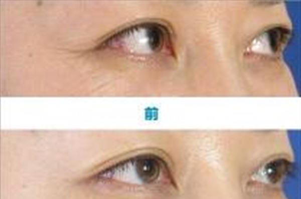 <a href=http://www.f3bb6.cn/listinfo-782-0.html target=_blank class=infotextkey>去眼角細(xì)紋</a>手術(shù)效果好不好？