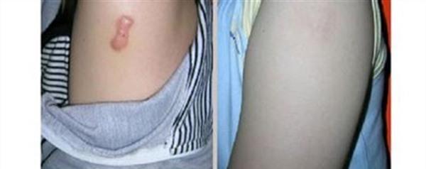 被燙傷的疤痕怎么去除