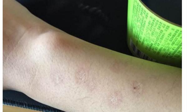 去疤什么時候做好