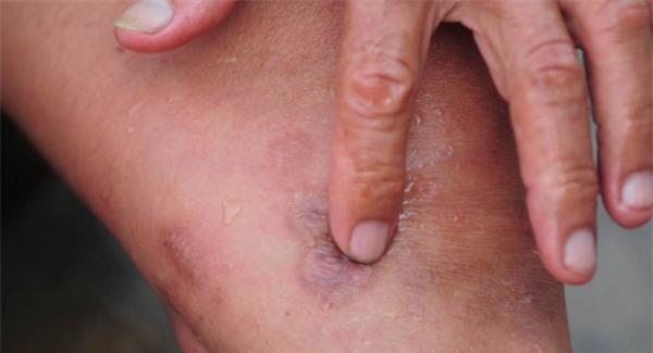 大腿燙傷留下疤痕應該怎么辦