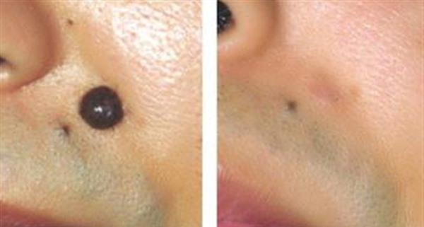 點(diǎn)痣留疤了怎么辦