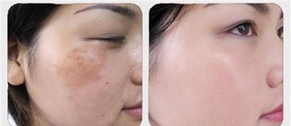 激光<a href=http://www.f3bb6.cn/listinfo-795-0.html target=_blank class=infotextkey>祛斑</a>反黑會恢復嗎？