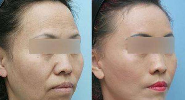 <a href=http://www.f3bb6.cn/listinfo-797-0.html target=_blank class=infotextkey>去痘疤</a>痘坑多少錢