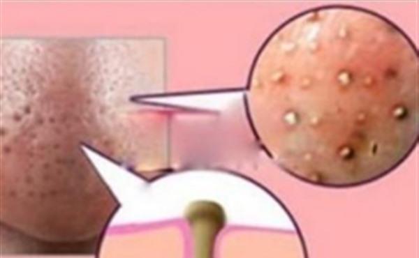 黑鼻頭形成的原因