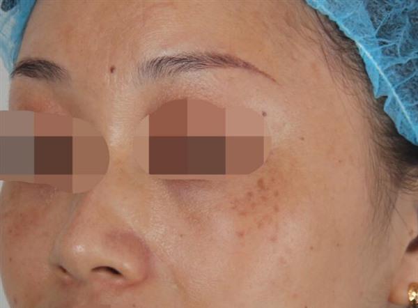 <a href=http://www.f3bb6.cn/listinfo-767-0.html target=_blank class=infotextkey>祛痣</a>的方法有哪些