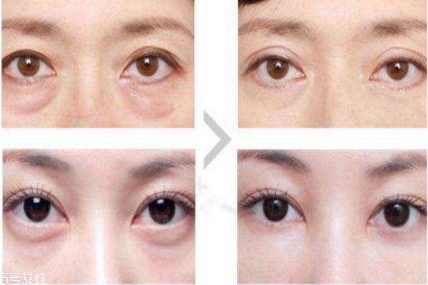 眼袋內切好還是外切好 <a href=http://www.f3bb6.cn/listinfo-708-0.html target=_blank class=infotextkey>去眼袋</a>內切和外切區別