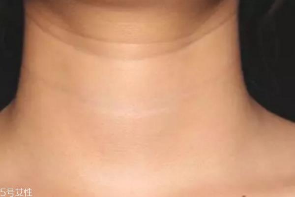 激光<a href=http://www.f3bb6.cn/listinfo-785-0.html target=_blank class=infotextkey>去頸紋</a>有用嗎 <a href=http://www.f3bb6.cn/listinfo-785-0.html target=_blank class=infotextkey>去頸紋</a>還有什么方式