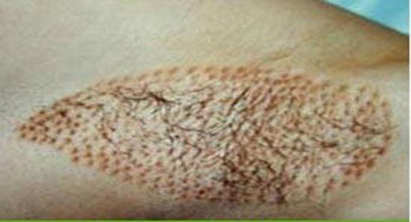 做電離子<a href=http://www.f3bb6.cn/listinfo-766-0.html target=_blank class=infotextkey>去腋臭</a>副作用