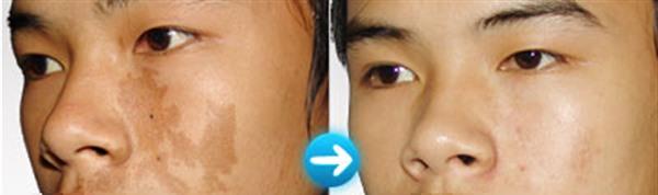 激光<a href=http://www.f3bb6.cn/listinfo-774-0.html target=_blank class=infotextkey>去雀斑</a>麻醉方式是什么？