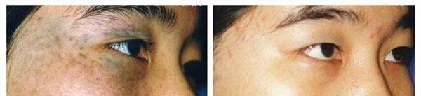 做皮膚磨削治太田痣風險有哪些