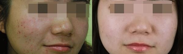 <a href=http://www.f3bb6.cn/listinfo-781-0.html target=_blank class=infotextkey>祛痘印</a>做完要多久時間？