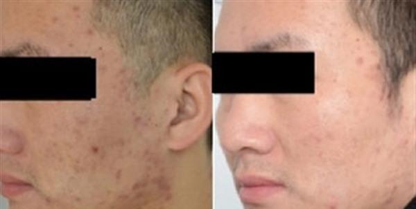 <a href=http://www.f3bb6.cn/listinfo-768-0.html target=_blank class=infotextkey>微針</a><a href=http://www.f3bb6.cn/listinfo-770-0.html target=_blank class=infotextkey>嫩膚</a>適應癥狀是什么？