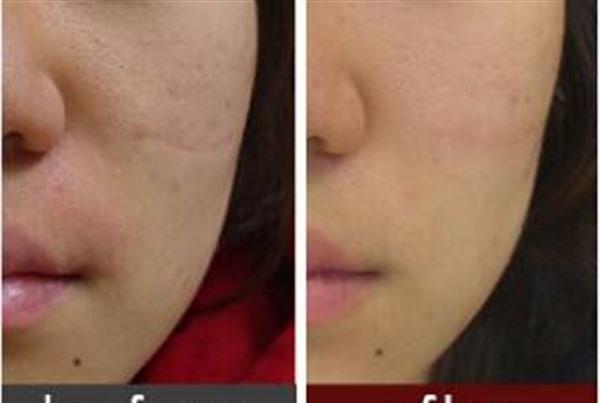 做<a href=http://www.f3bb6.cn/listinfo-797-0.html target=_blank class=infotextkey>去痘疤</a>失敗修復風險有哪些