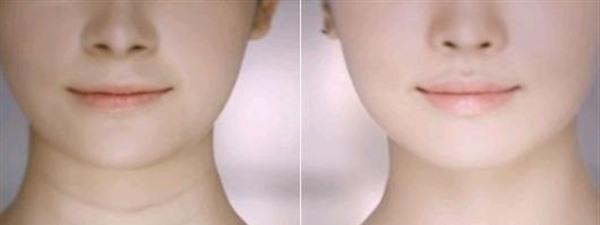 <a href=http://www.f3bb6.cn/listinfo-731-0.html target=_blank class=infotextkey>玻尿酸</a>除頸紋手術(shù)缺點(diǎn)有哪些？