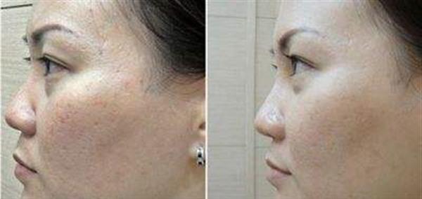 做自體脂肪<a href=http://www.f3bb6.cn/listinfo-797-0.html target=_blank class=infotextkey>去痘疤</a>價格要多少