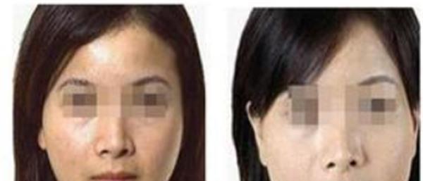 做自體脂肪<a href=http://www.f3bb6.cn/listinfo-797-0.html target=_blank class=infotextkey>去痘疤</a>價格多少錢