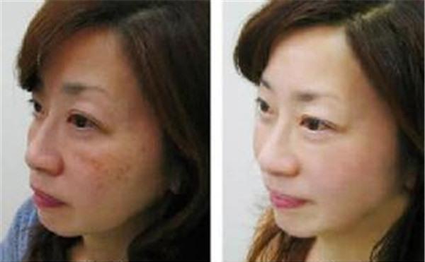 做冷凍法<a href=http://www.f3bb6.cn/listinfo-786-0.html target=_blank class=infotextkey>去黃褐斑</a>價(jià)格