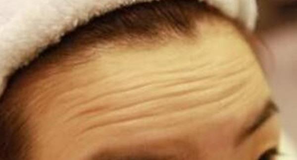 做額顳部<a href=http://www.f3bb6.cn/listinfo-614-0.html target=_blank class=infotextkey>除皺</a><a href=http://www.f3bb6.cn/listinfo-765-0.html target=_blank class=infotextkey>去抬頭紋</a>價格是多少