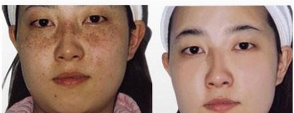 做彩光<a href=http://www.f3bb6.cn/listinfo-795-0.html target=_blank class=infotextkey>祛斑</a>價格貴不貴