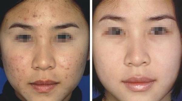 做光子去痘印費用大概需要多少