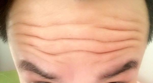 做激光去除抬頭紋手術注意事項是什么？