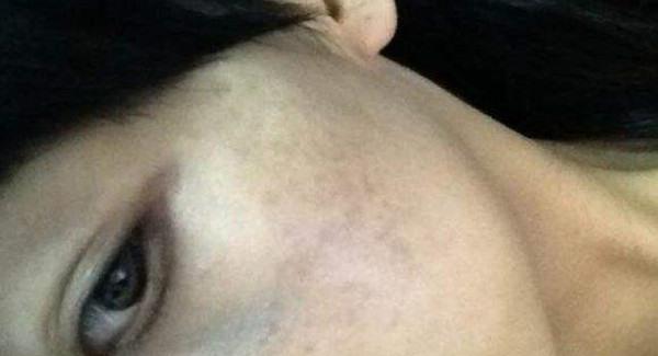 做剝脫治療<a href=http://www.f3bb6.cn/listinfo-774-0.html target=_blank class=infotextkey>去雀斑</a>手術注意事項是什么？