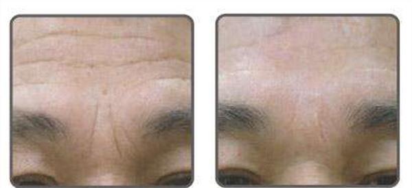 自體脂肪<a href=http://www.f3bb6.cn/listinfo-771-0.html target=_blank class=infotextkey>去眉間紋</a>手術安全嗎？