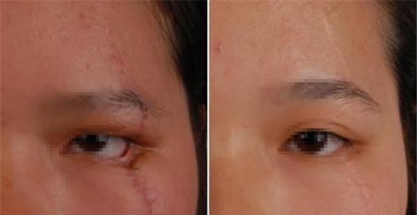 面部疤痕修復(fù)效果好不好？