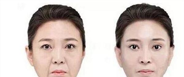 做自體脂肪<a href=http://www.f3bb6.cn/listinfo-792-0.html target=_blank class=infotextkey>去法令紋</a>多少錢