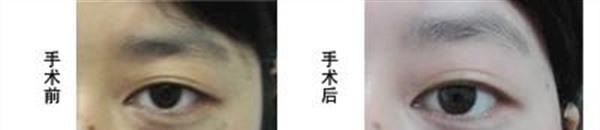 激光<a href=http://www.f3bb6.cn/listinfo-799-0.html target=_blank class=infotextkey>去太田痣</a>手術(shù)注意事項是什么？