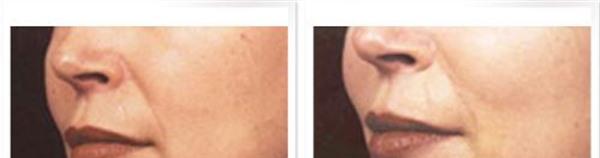 <a href=http://www.f3bb6.cn/listinfo-792-0.html target=_blank class=infotextkey>去法令紋</a>失敗修復(fù)手術(shù)注意事項(xiàng)是什么?