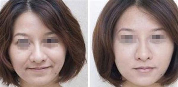 自體脂肪<a href=http://www.f3bb6.cn/listinfo-792-0.html target=_blank class=infotextkey>去法令紋</a>手術效果好不好?