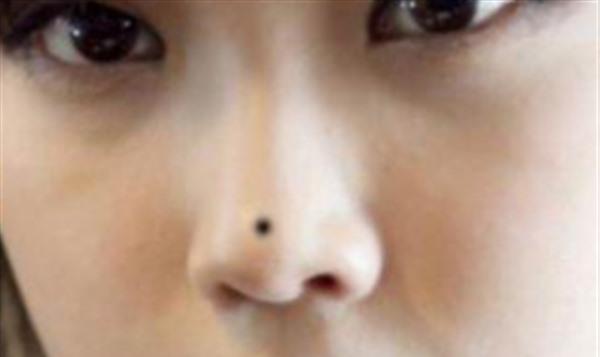 鼻頭有痣能去掉嗎