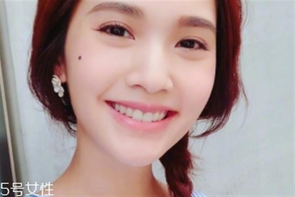 點痣能吃魚嗎 魚屬于發物