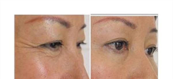 微晶磨皮<a href=http://www.f3bb6.cn/listinfo-780-0.html target=_blank class=infotextkey>去魚尾紋</a>維持時間是多久？