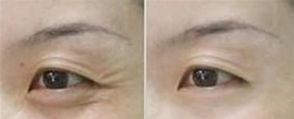 做<a href=http://www.f3bb6.cn/listinfo-734-0.html target=_blank class=infotextkey>愛貝芙</a><a href=http://www.f3bb6.cn/listinfo-780-0.html target=_blank class=infotextkey>去魚尾紋</a>費用多少錢