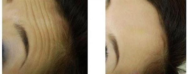 做內(nèi)窺鏡<a href=http://www.f3bb6.cn/listinfo-614-0.html target=_blank class=infotextkey>除皺</a><a href=http://www.f3bb6.cn/listinfo-765-0.html target=_blank class=infotextkey>去抬頭紋</a>費用大概需要多少