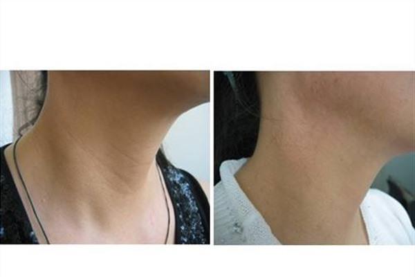 <a href=http://www.f3bb6.cn/listinfo-785-0.html target=_blank class=infotextkey>去頸紋</a>手術(shù)安全嗎？