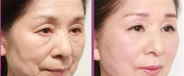 做青春解碼儀美膚不適應人群有哪些