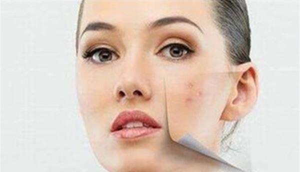 光子祛痘反彈嗎