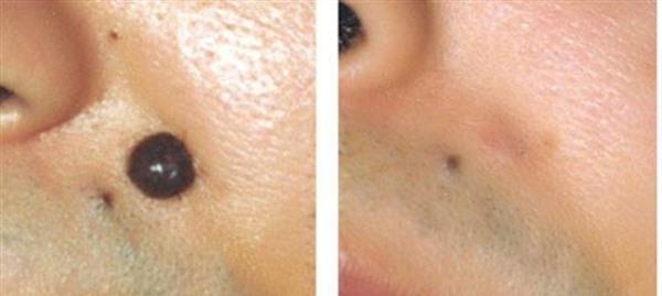 做冷凍去痣費(fèi)用大概需要多少