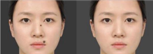 做E光點痣不適應人群有哪些